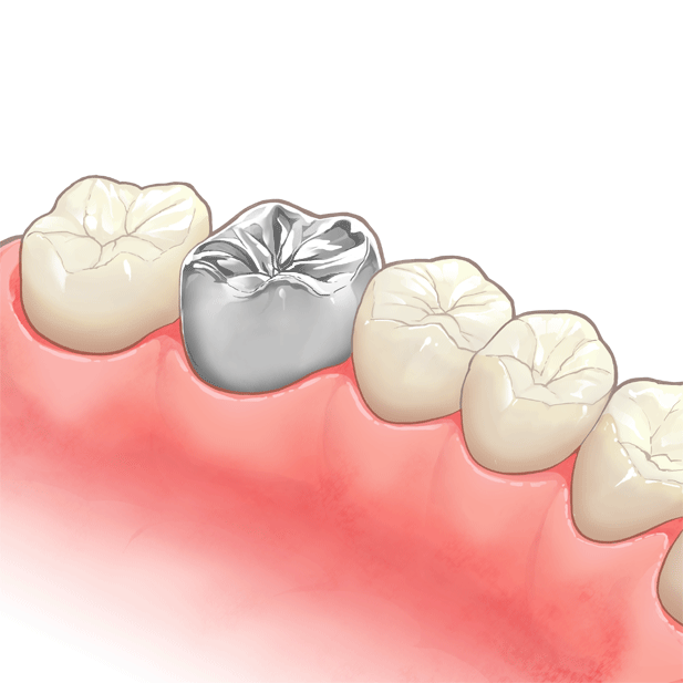 保険銀歯のデメリット