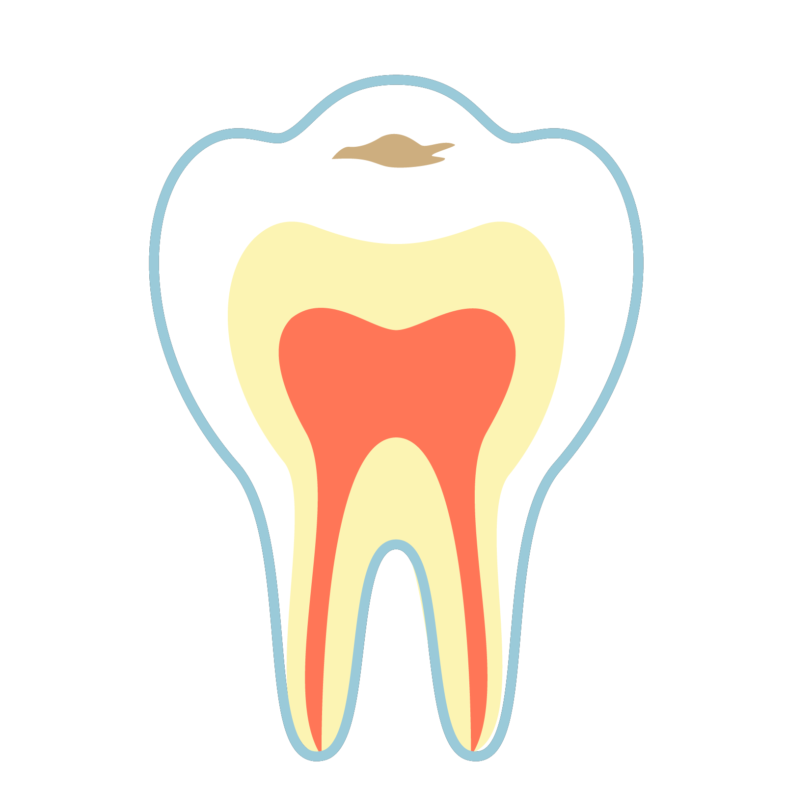 C1　エナメル質のむし歯
