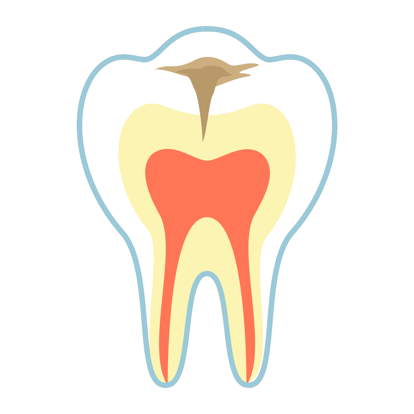 C2　象牙質に達したむし歯