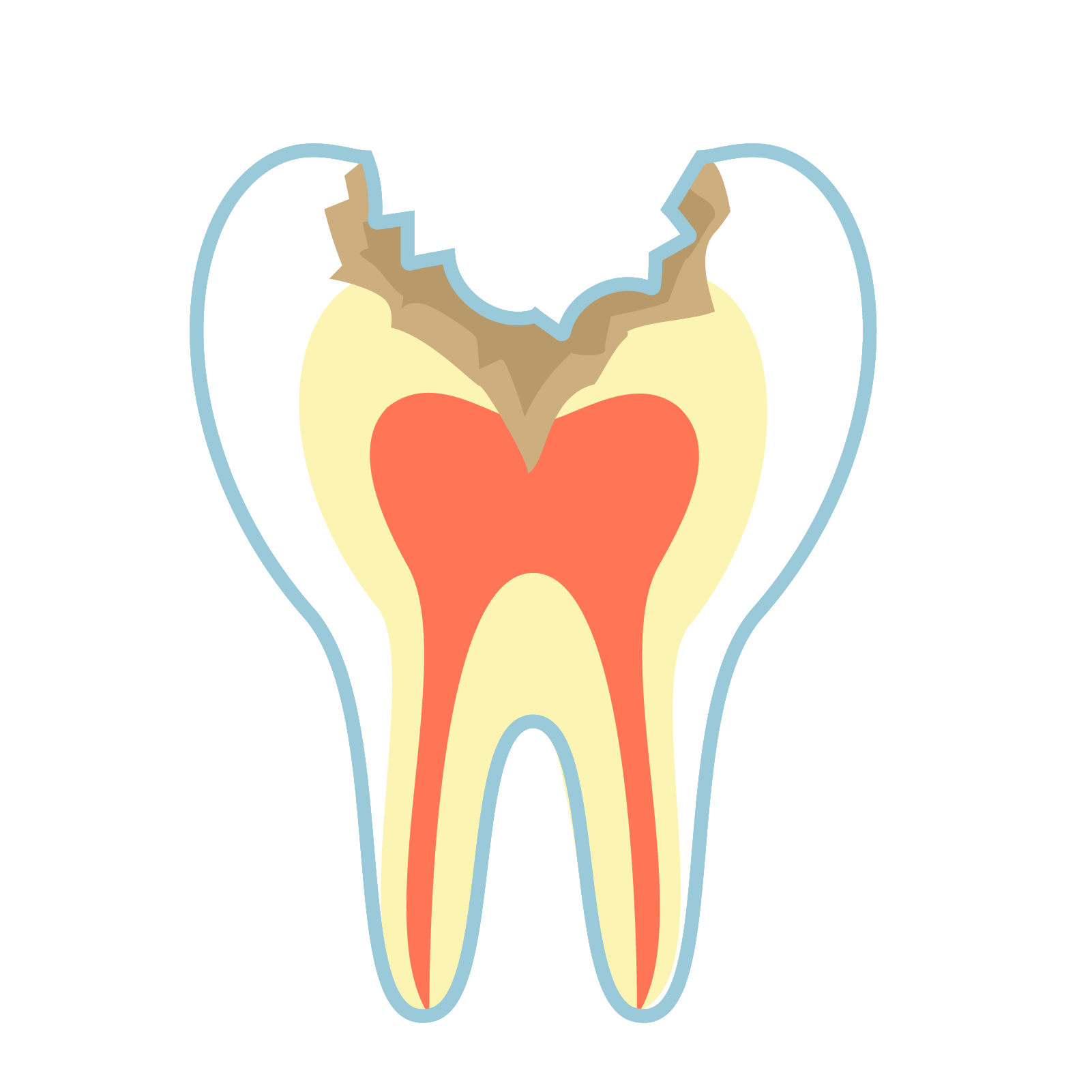 C3　神経 (歯髄)に達したむし歯