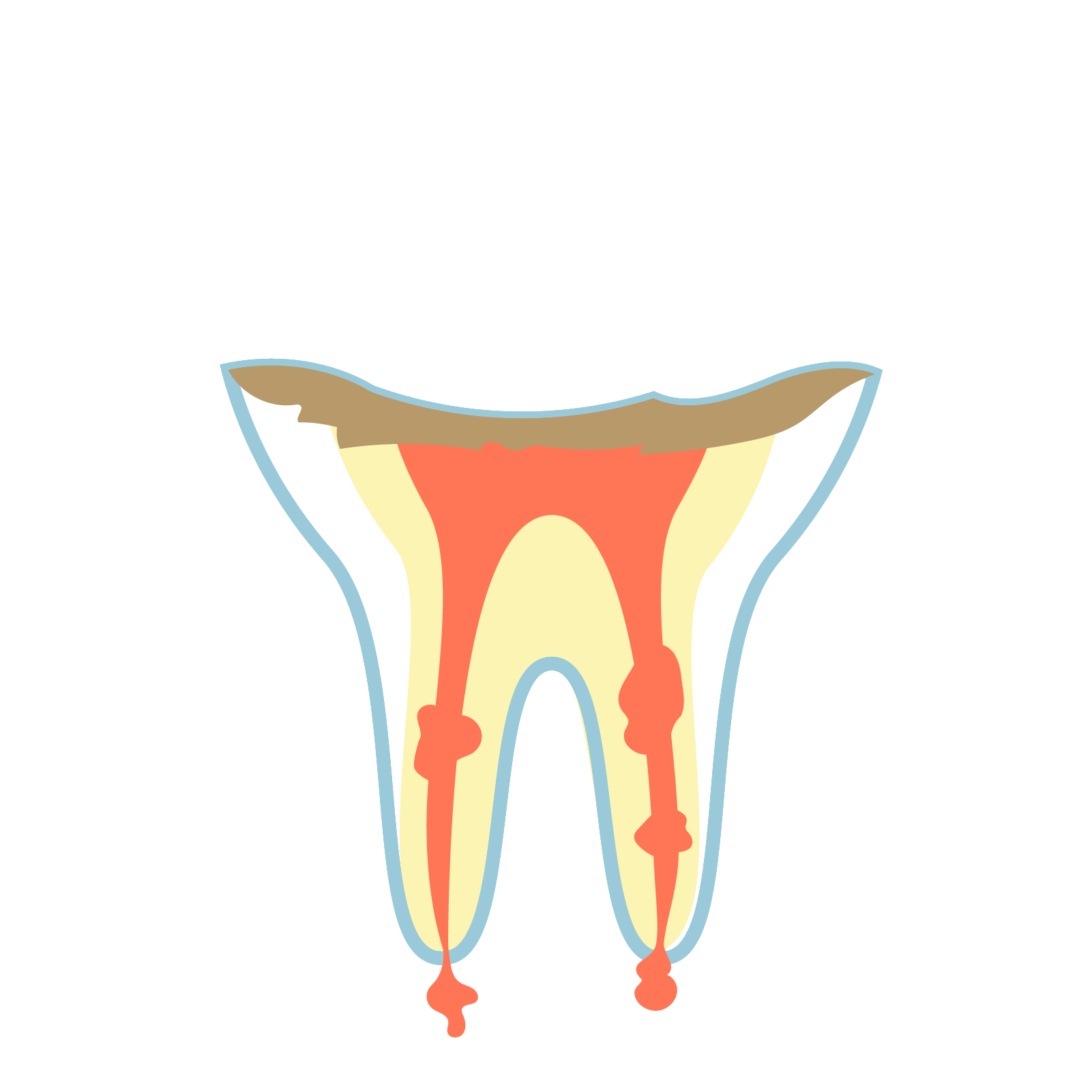 C4　歯質が失われたむし歯