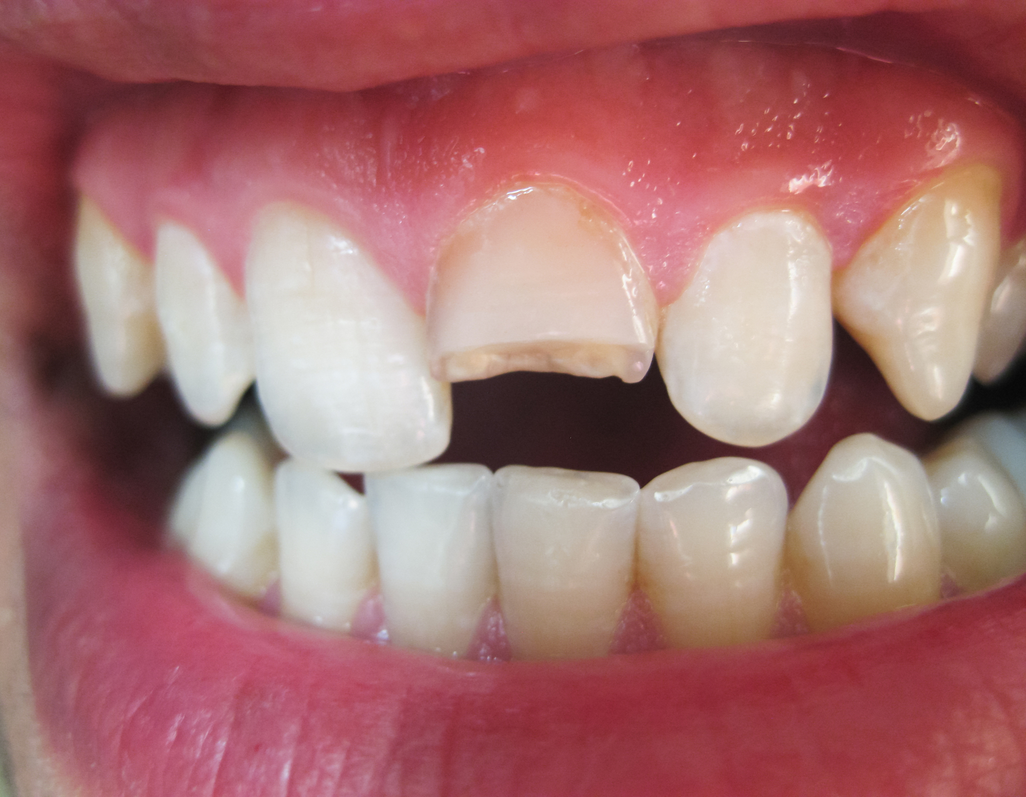 事故や転倒による歯の外傷